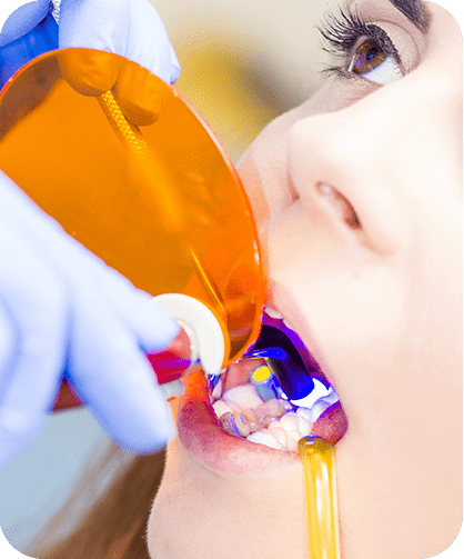 Cosmetic Tooth Bonding | Neighbourhood Dental | General & Family Dentist | Blackfalds, AB