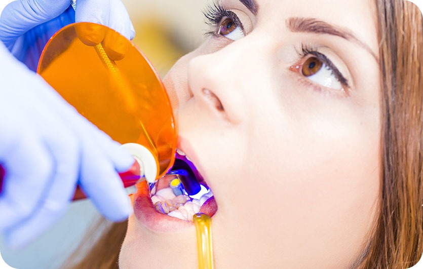 Cosmetic Tooth Bonding | Neighbourhood Dental | General & Family Dentist | Blackfalds, AB