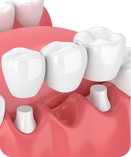 Dental Bridges | Neighbourhood Dental | General & Family Dentist | Blackfalds, AB