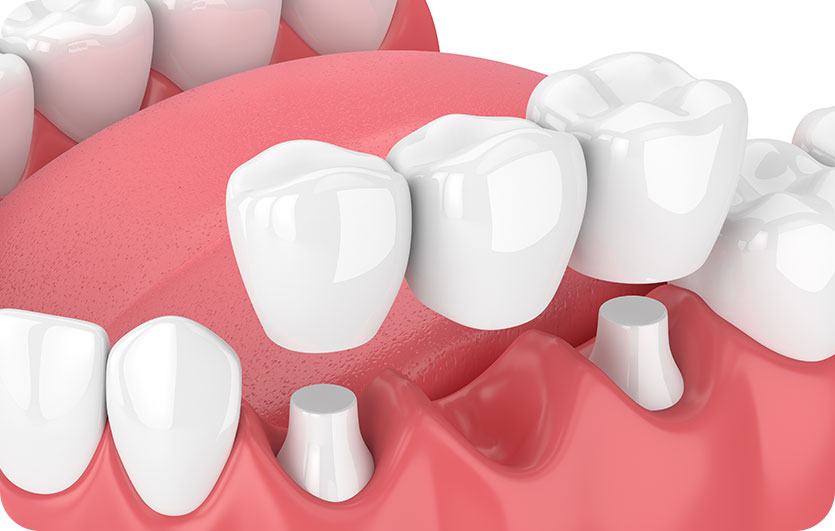 Dental Bridges | Neighbourhood Dental | General & Family Dentist | Blackfalds, AB