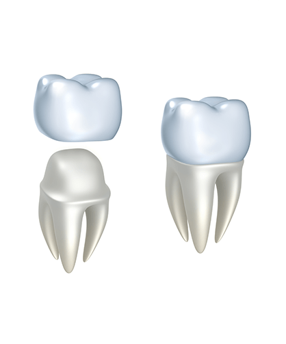 Dental Crowns | Neighbourhood Dental | General & Family Dentist | Blackfalds, AB