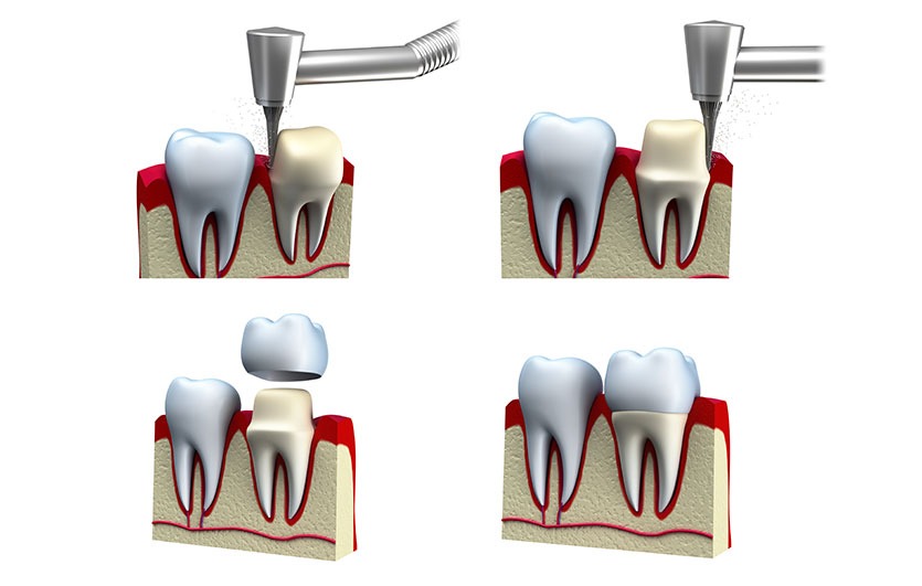 Dental Crowns | Neighbourhood Dental | General & Family Dentist | Blackfalds, AB