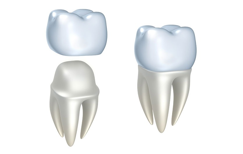 Dental Crowns | Neighbourhood Dental | General & Family Dentist | Blackfalds, AB