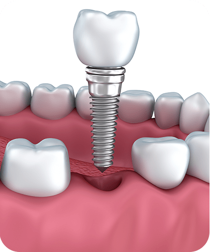 Dental Implants | Neighbourhood Dental | General & Family Dentist | Blackfalds, AB
