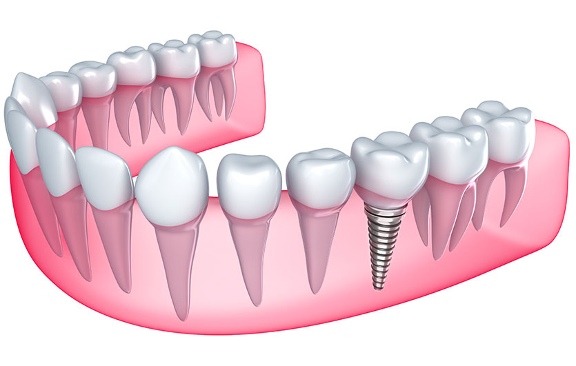 Dental Implants | Neighbourhood Dental | General & Family Dentist | Blackfalds