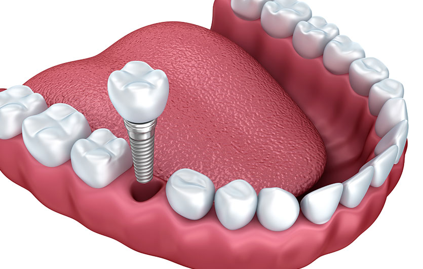 Dental Implants | Neighbourhood Dental | General & Family Dentist | Blackfalds