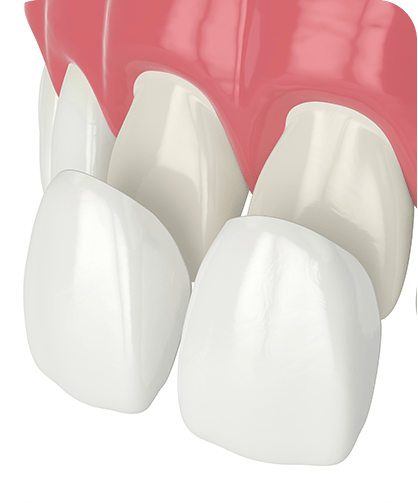 Porcelain Veneers | Neighbourhood Dental | General & Family Dentist | Blackfalds, AB