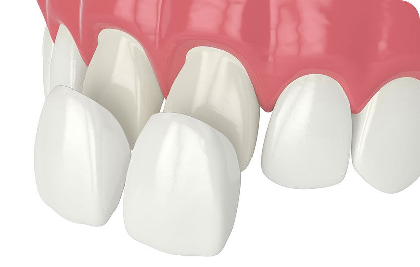 Porcelain Veneers | Neighbourhood Dental | General & Family Dentist | Blackfalds, AB