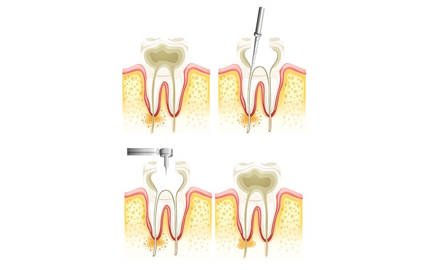 Root Canal Therapy | Neighbourhood Dental | General & Family Dentist | Blackfalds, AB
