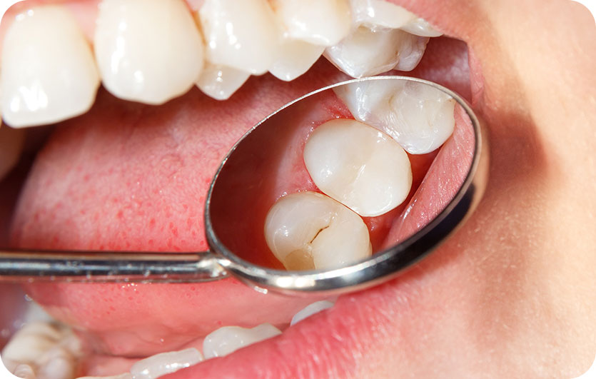 White Fillings | Neighbourhood Dental | General & Family Dentist | Blackfalds