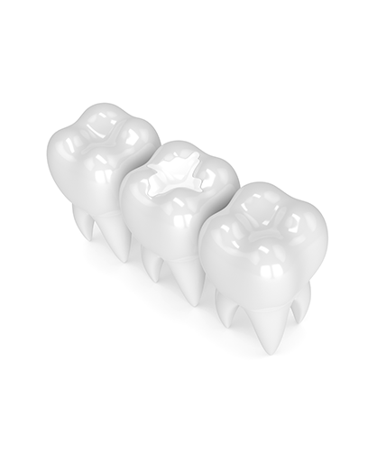 White Fillings | Neighbourhood Dental | General & Family Dentist | Blackfalds, AB