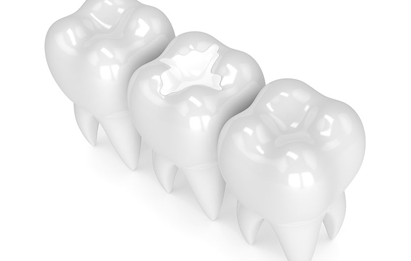 White Fillings | Neighbourhood Dental | General & Family Dentist | Blackfalds