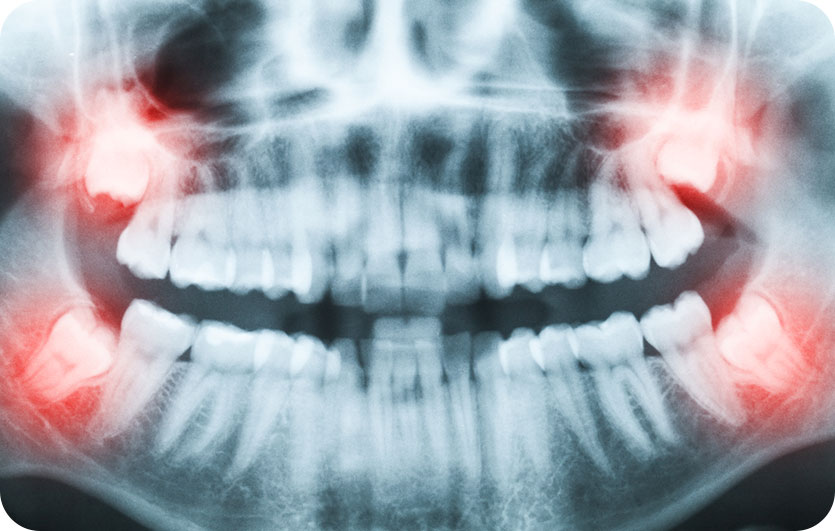Wisdom Teeth Extractions | Neighbourhood Dental | General & Family Dentist | Blackfalds