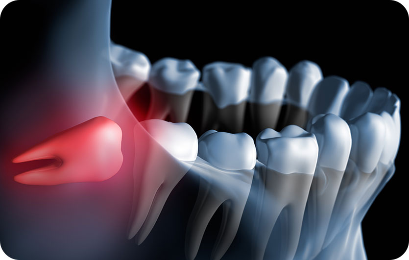 Wisdom Teeth Extractions | Neighbourhood Dental | General & Family Dentist | Blackfalds